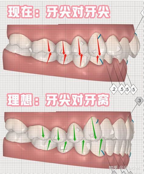 上排牙齒蓋住下排牙齒|牙齒咬合重要嗎？原來上下排牙齒咬合沒那麼簡單